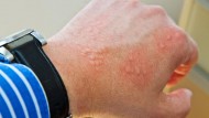 skin problems at work