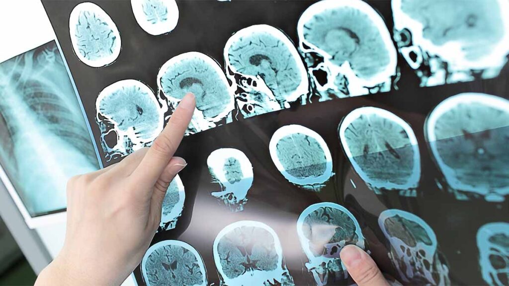 Brain scans showing signs of multiple sclerosis