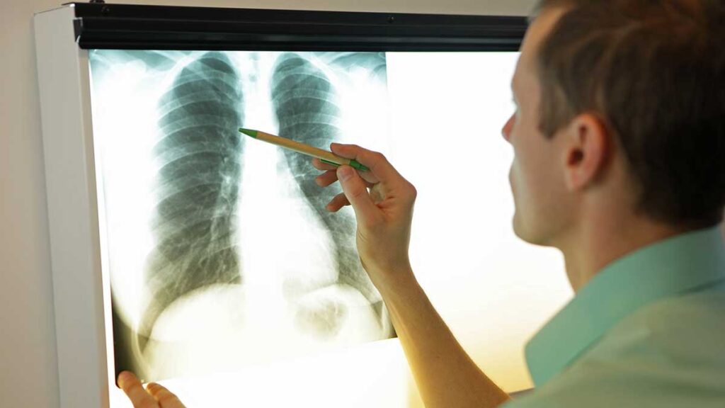 An x-ray showing the lungs
