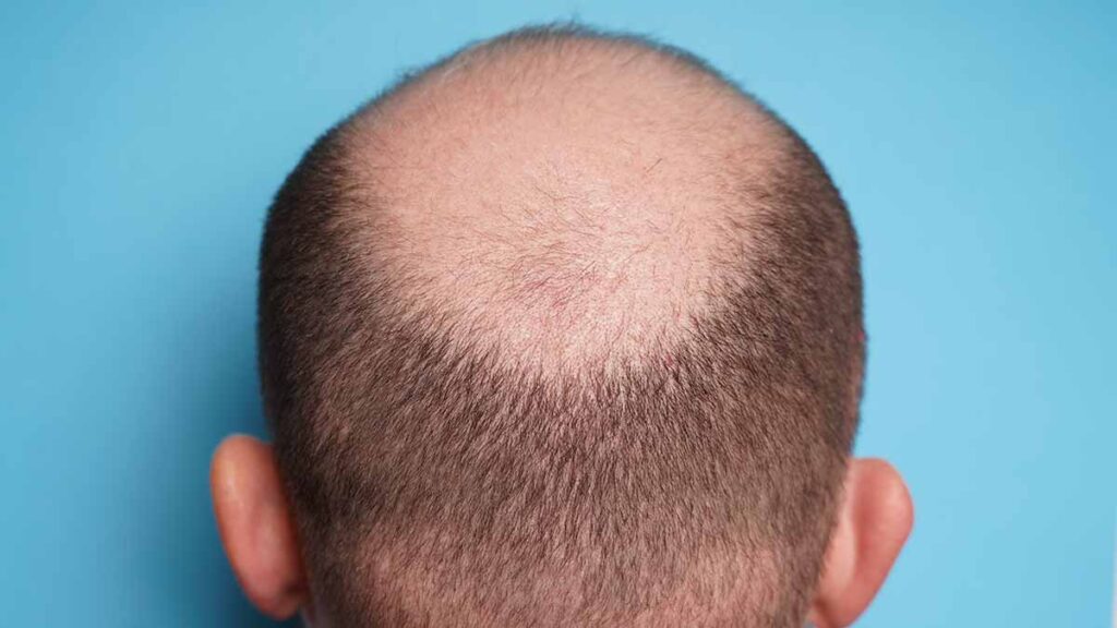 Is calling someone bald harassment?